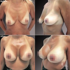 Уголемяване на гърди | Пациент 7