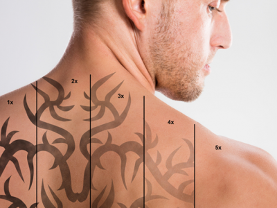 Отстраняване на татуировки